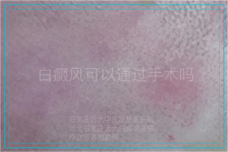 白癜风可以通过手术吗