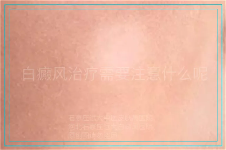 白癜风治疗需要注意什么呢