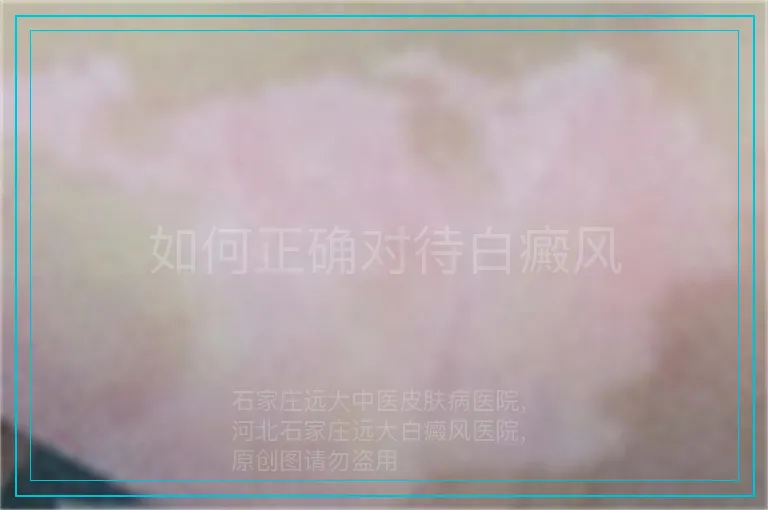 如何正确对待白癜风