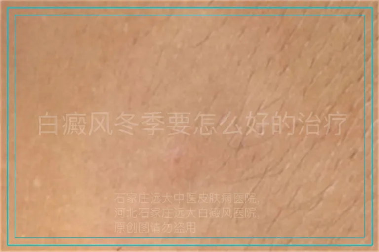 白癜风冬季要怎么好的治疗