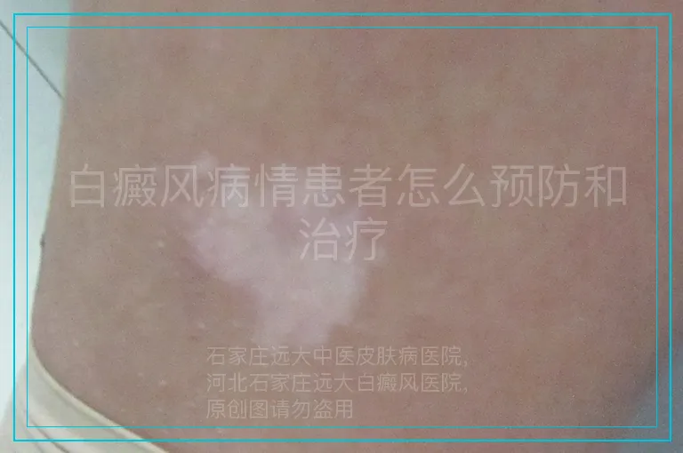 白癜风病情患者怎么预防和治疗