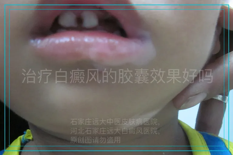 治疗白癜风的胶囊效果好吗