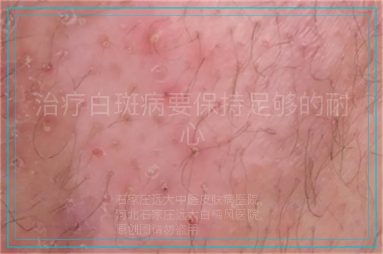 治疗白斑病要保持足够的耐心