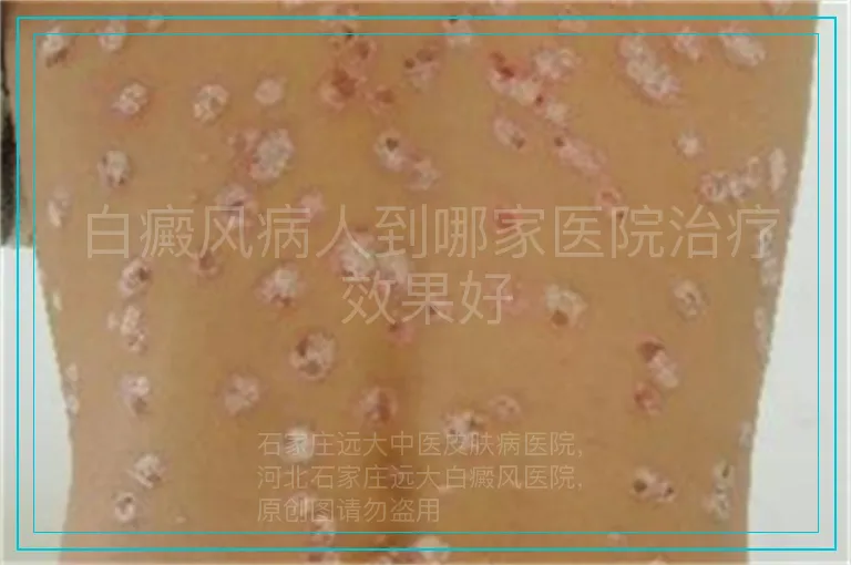白癜风病人到哪家医院治疗效果好