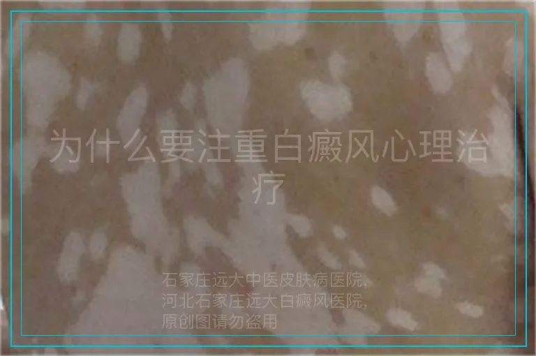 为什么要注重白癜风心理治疗