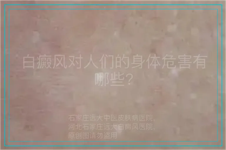 白癜风对人们的身体危害有哪些?
