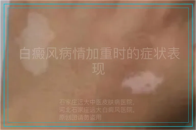 白癜风病情加重时的症状表现