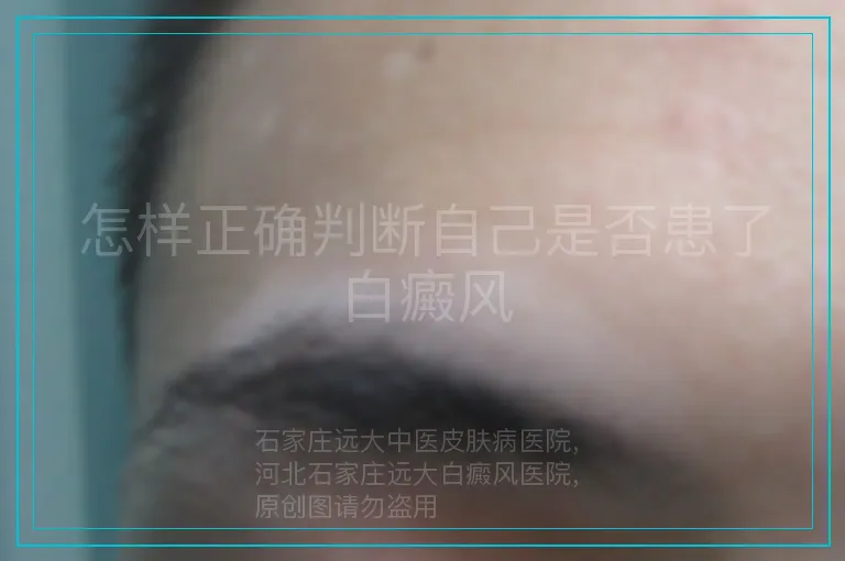 怎样正确判断自己是否患了白癜风