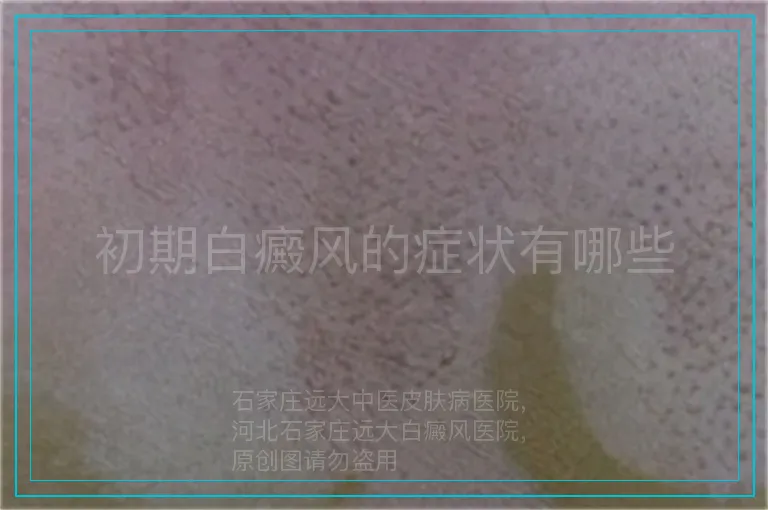 初期白癜风的症状有哪些