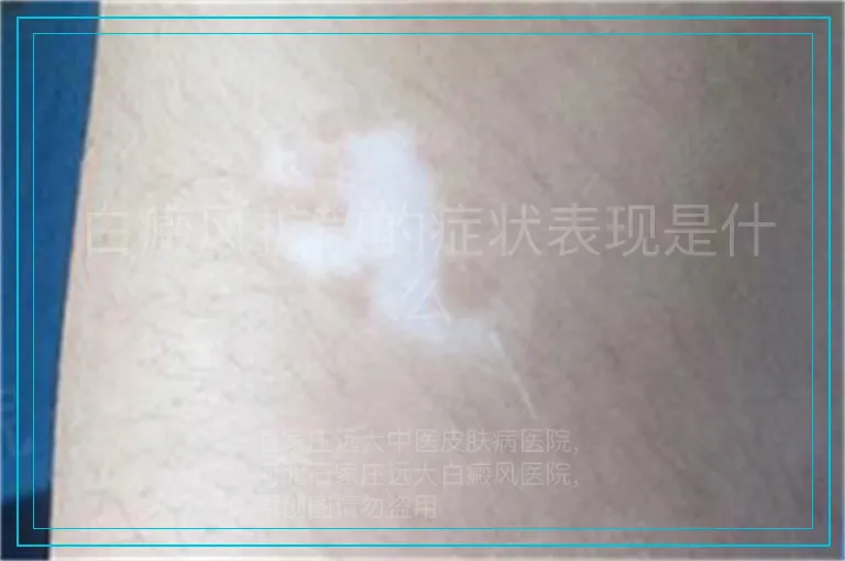白癜风扩散的症状表现是什么