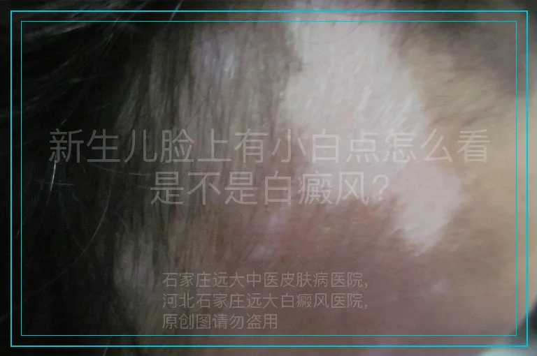 新生儿脸上有小白点怎么看是不是白癜风?