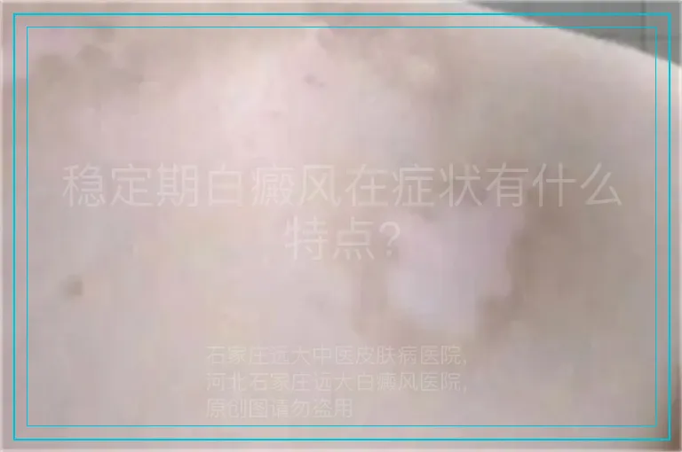 稳定期白癜风在症状有什么特点?