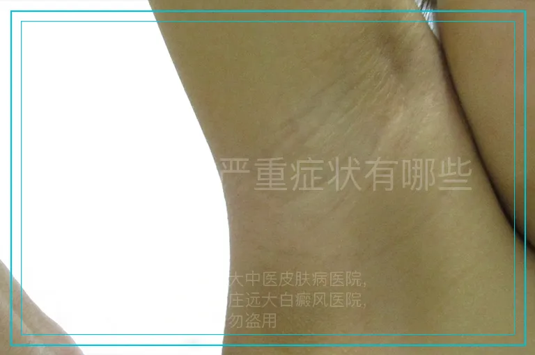 白癜风的严重症状有哪些