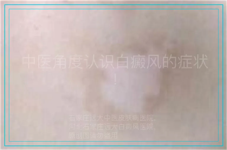 中医角度认识白癜风的症状!