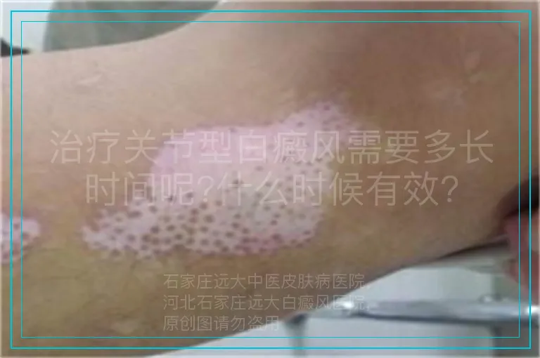 治疗关节型白癜风需要多长时间呢?什么时候有效?