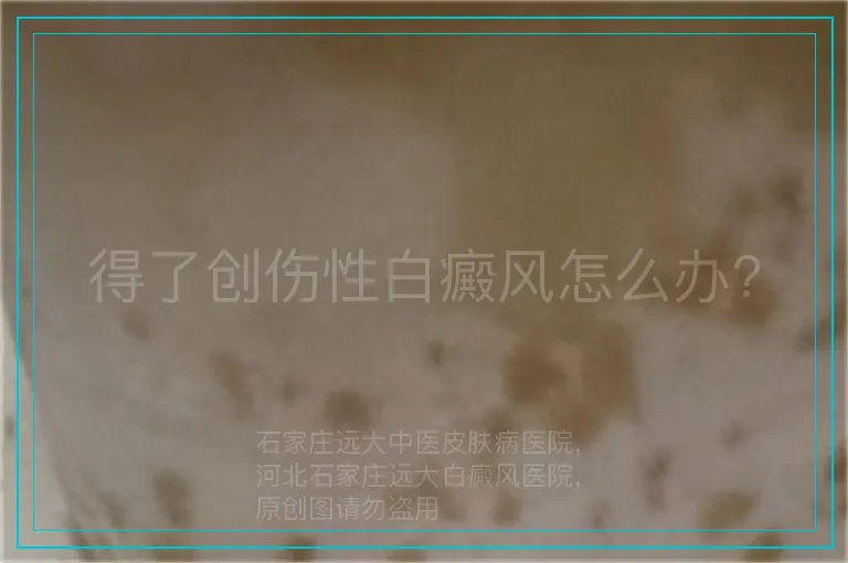 得了创伤性白癜风怎么办?