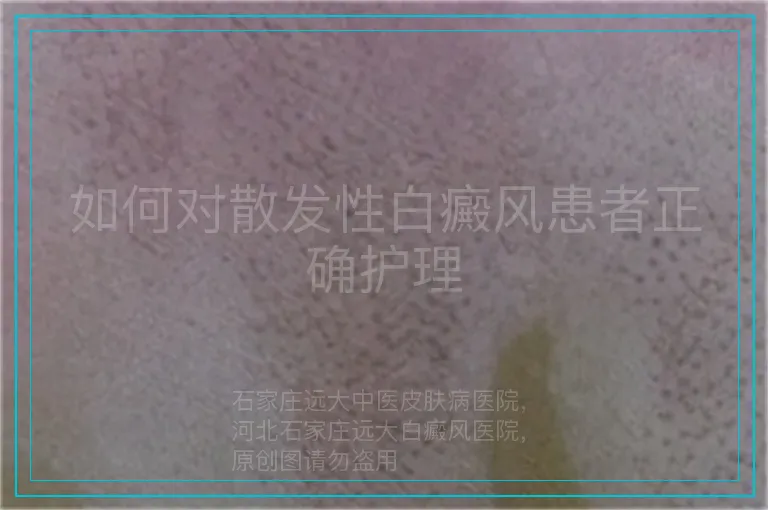 如何对散发性白癜风患者正确护理