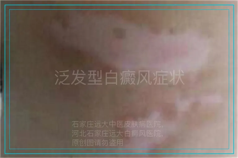 泛发型白癜风症状
