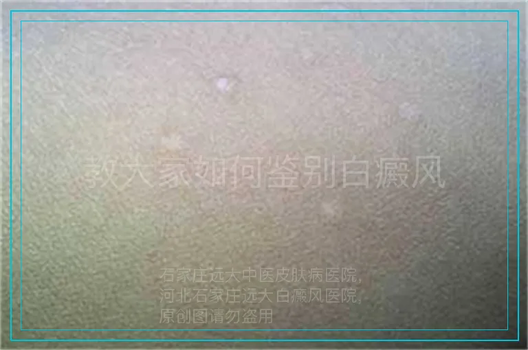 教大家如何鉴别白癜风