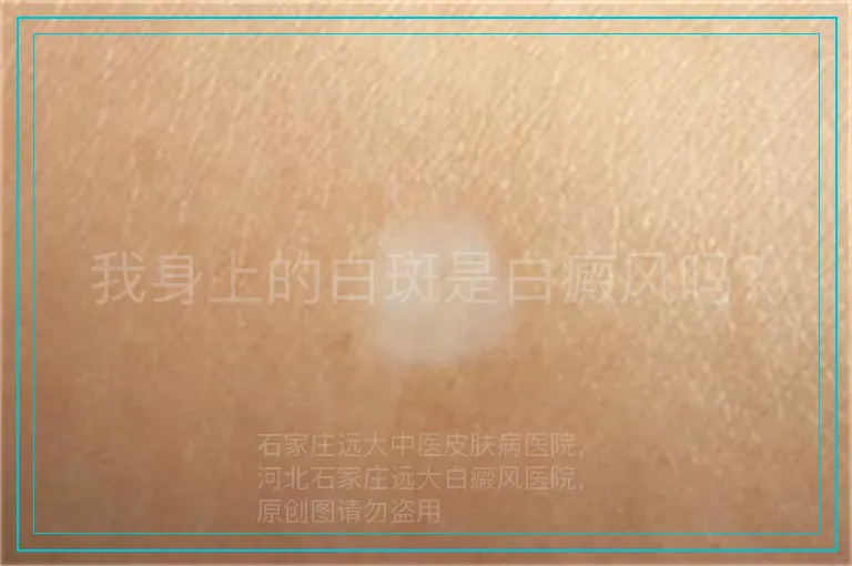 我身上的白斑是白癜风吗？