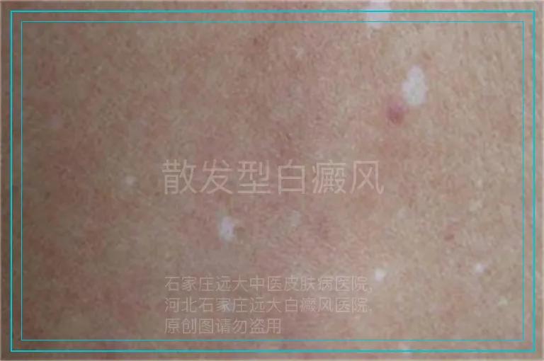 散发型白癜风