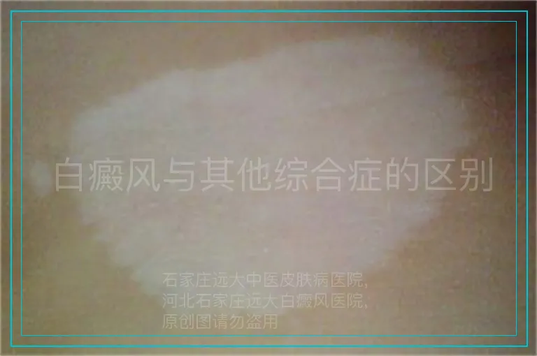 白癜风与其他综合症的区别