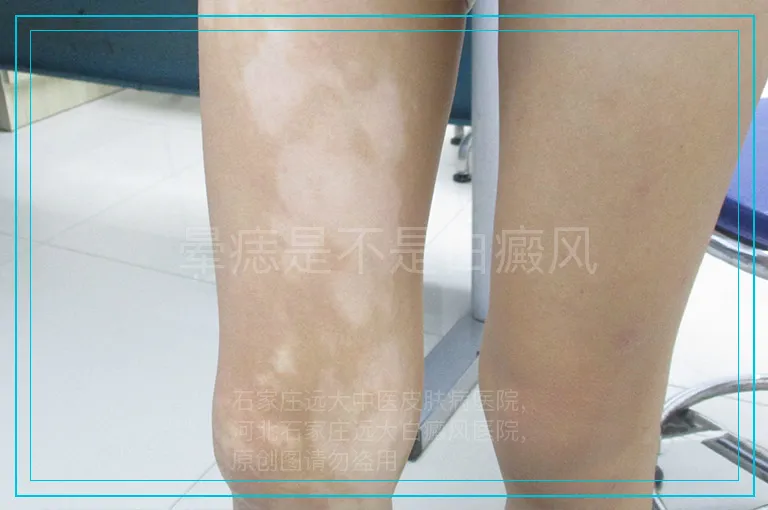晕痣是不是白癜风