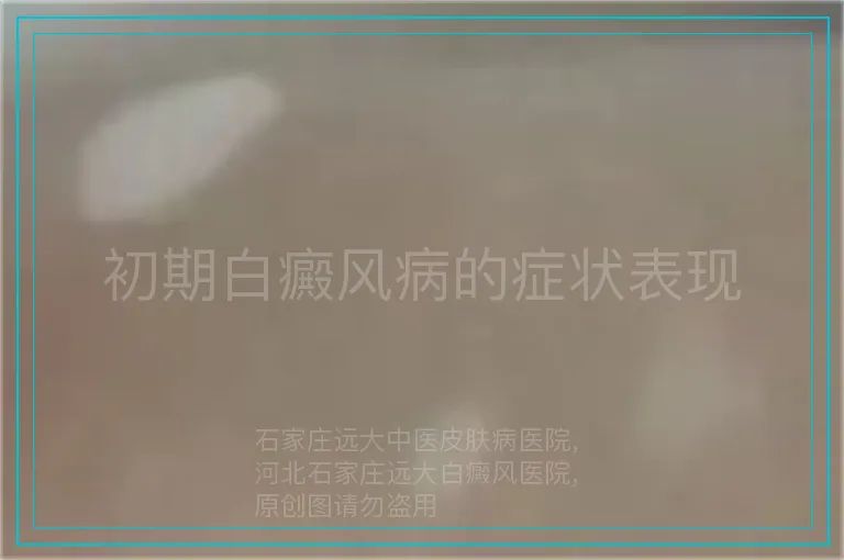 初期白癜风病的症状表现