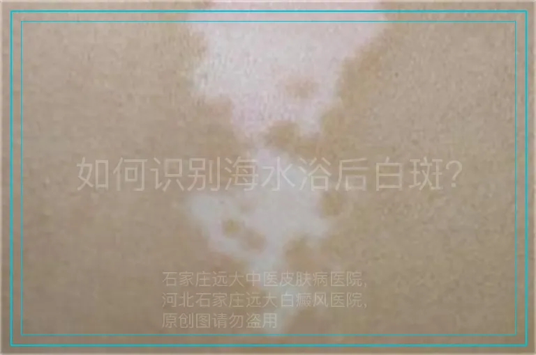 如何识别海水浴后白斑？