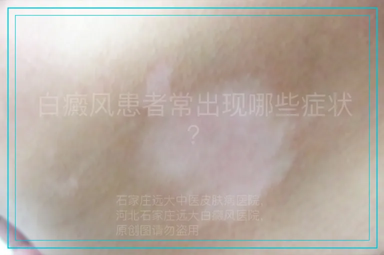 白癜风患者常出现哪些症状?