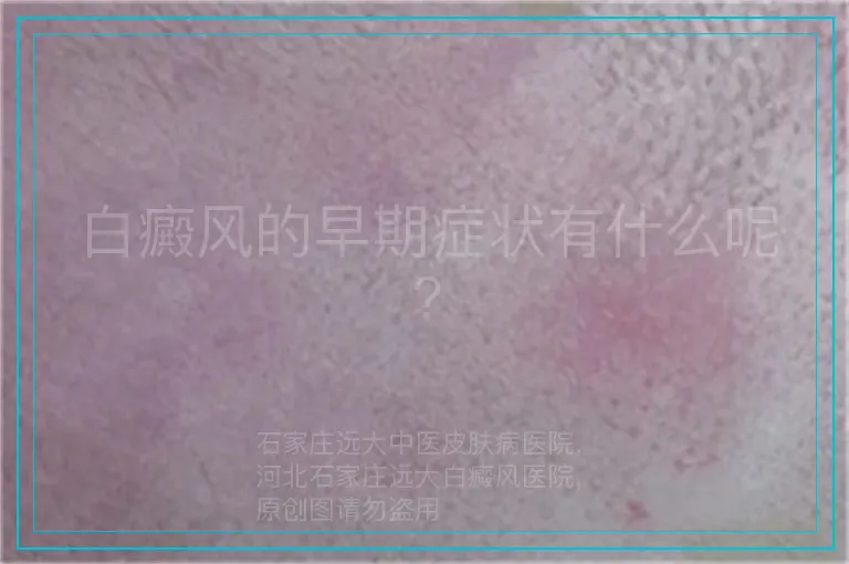 白癜风的早期症状有什么呢?