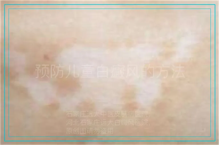 预防儿童白癜风的方法