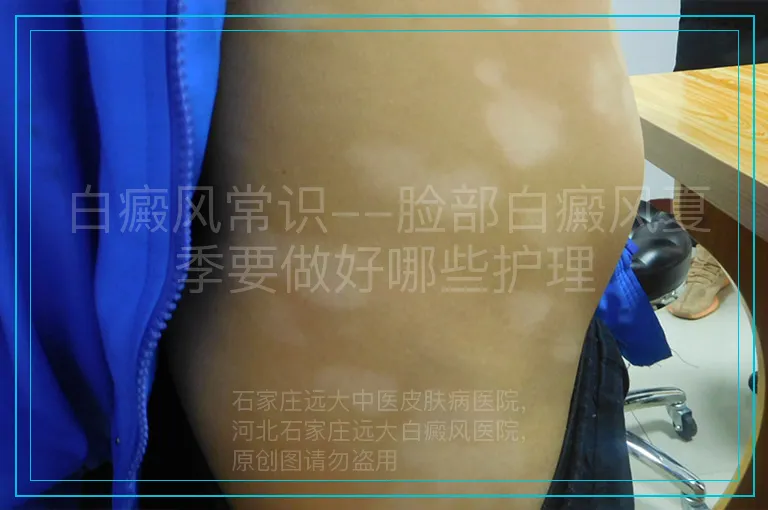 白癜风常识--脸部白癜风夏季要做好哪些护理