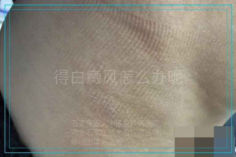 得白癜风怎么办呢
