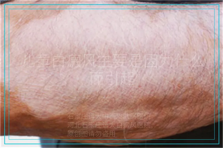 儿童白癜风主要是因为什么而引起