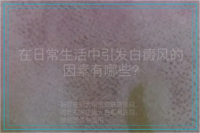 在日常生活中引发白癜风的因素有哪些?