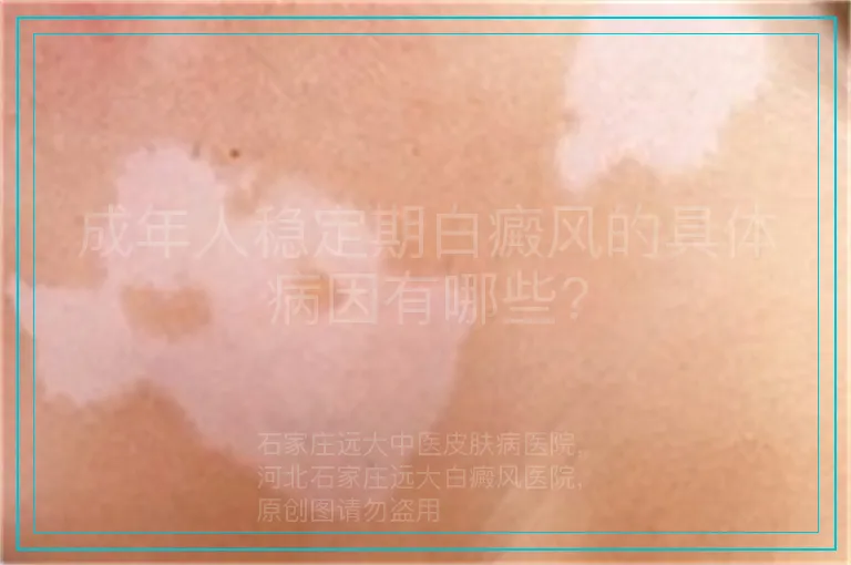 成年人稳定期白癜风的具体病因有哪些?