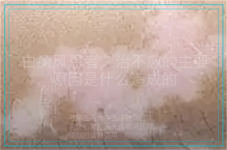 白癜风患者久治不愈的主要原因是什么造成的