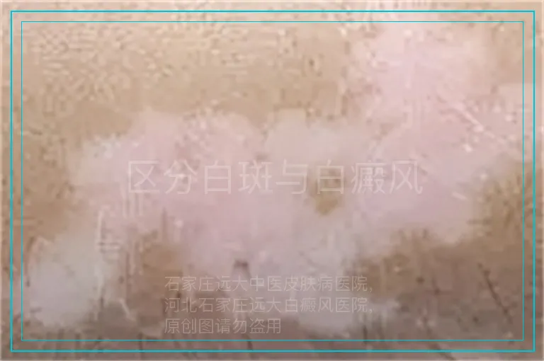 区分白斑与白癜风