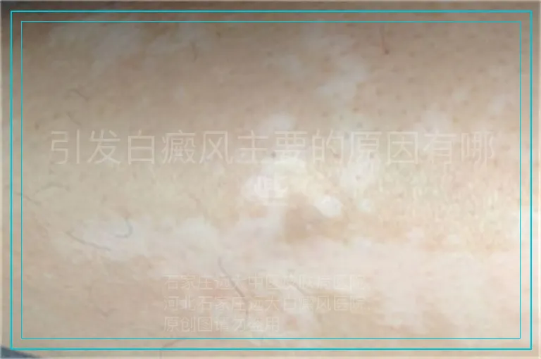 引发白癜风主要的原因有哪些