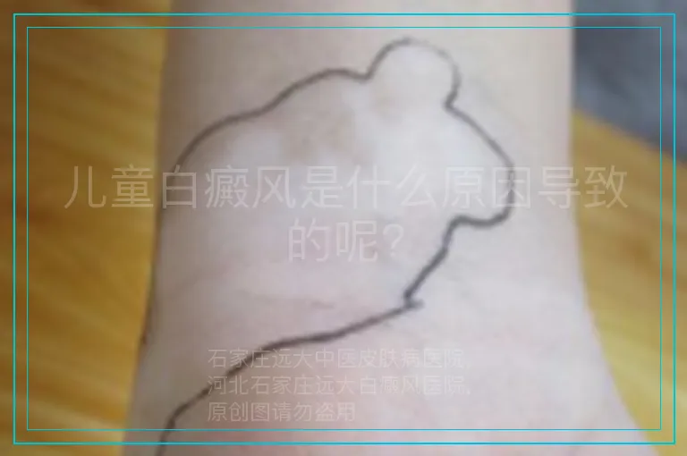 儿童白癜风是什么原因导致的呢?