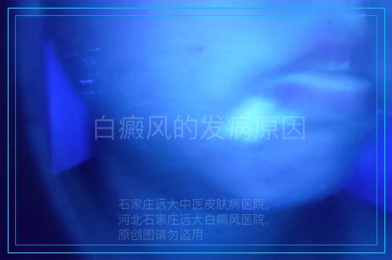 白癜风的发病原因