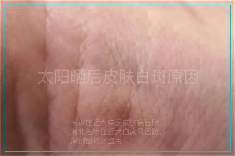 太阳晒后皮肤白斑原因