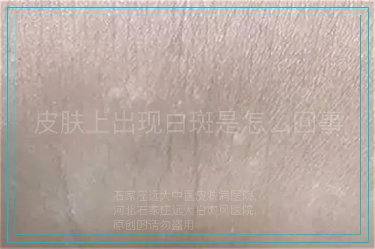 皮肤上出现白斑是怎么回事