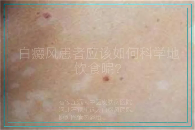 白癜风患者应该如何科学地饮食呢?