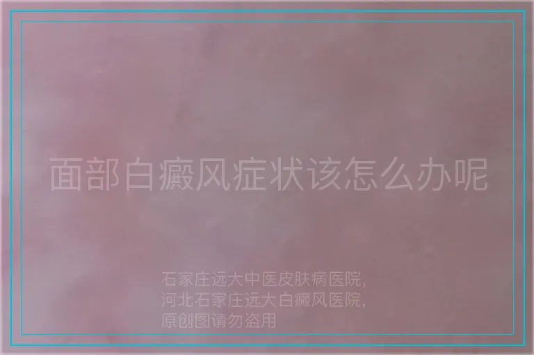面部白癜风症状该怎么办呢