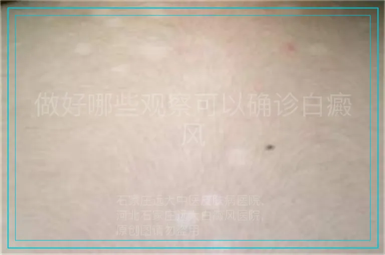做好哪些观察可以确诊白癜风