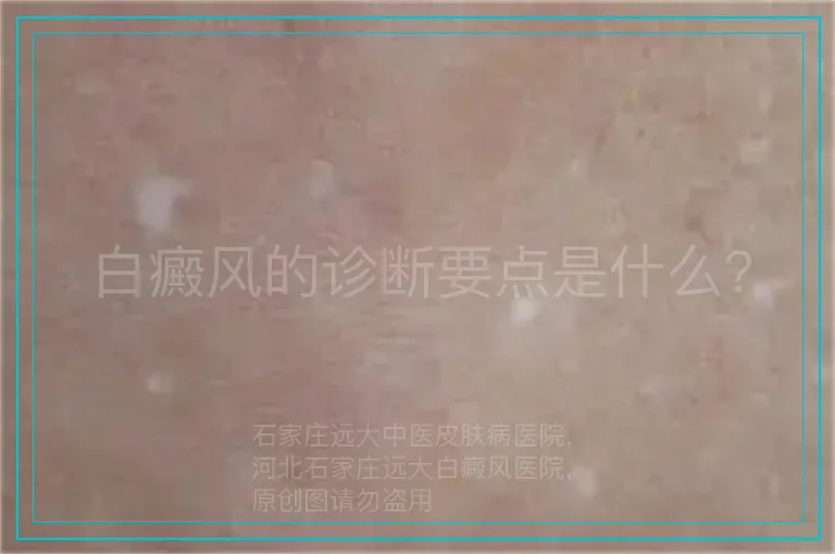 白癜风的诊断要点是什么？