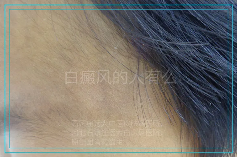 白癜风的人有么