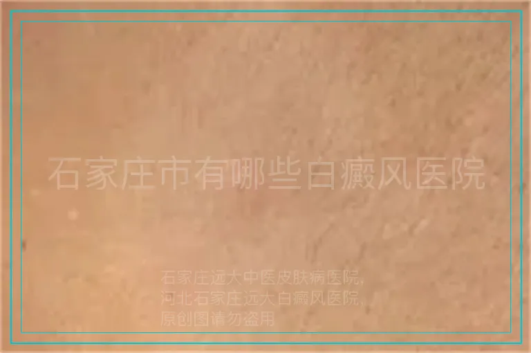 石家庄市有哪些白癜风医院